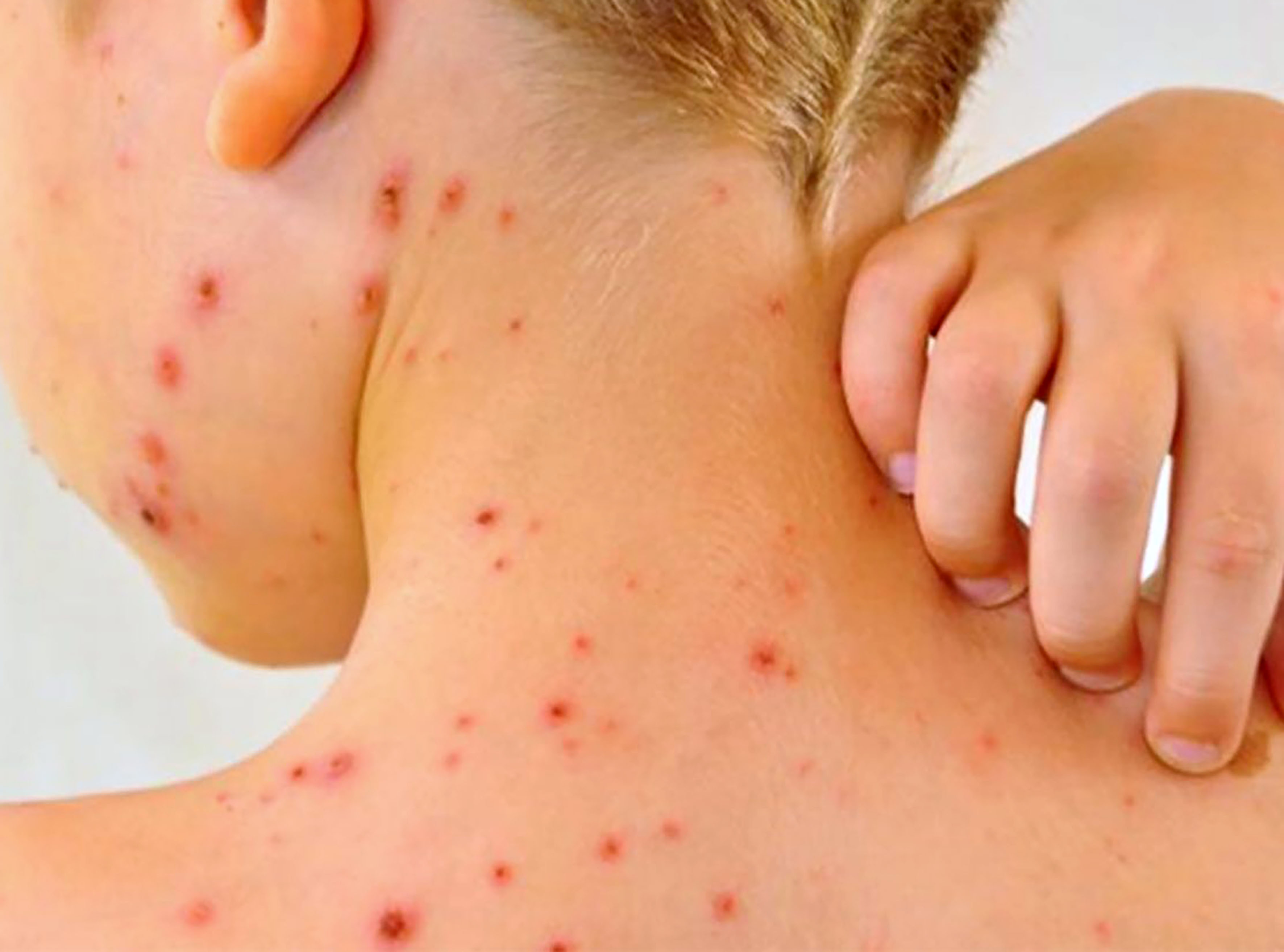 Sarampión en México: Salud confirma la primera muerte en 2026